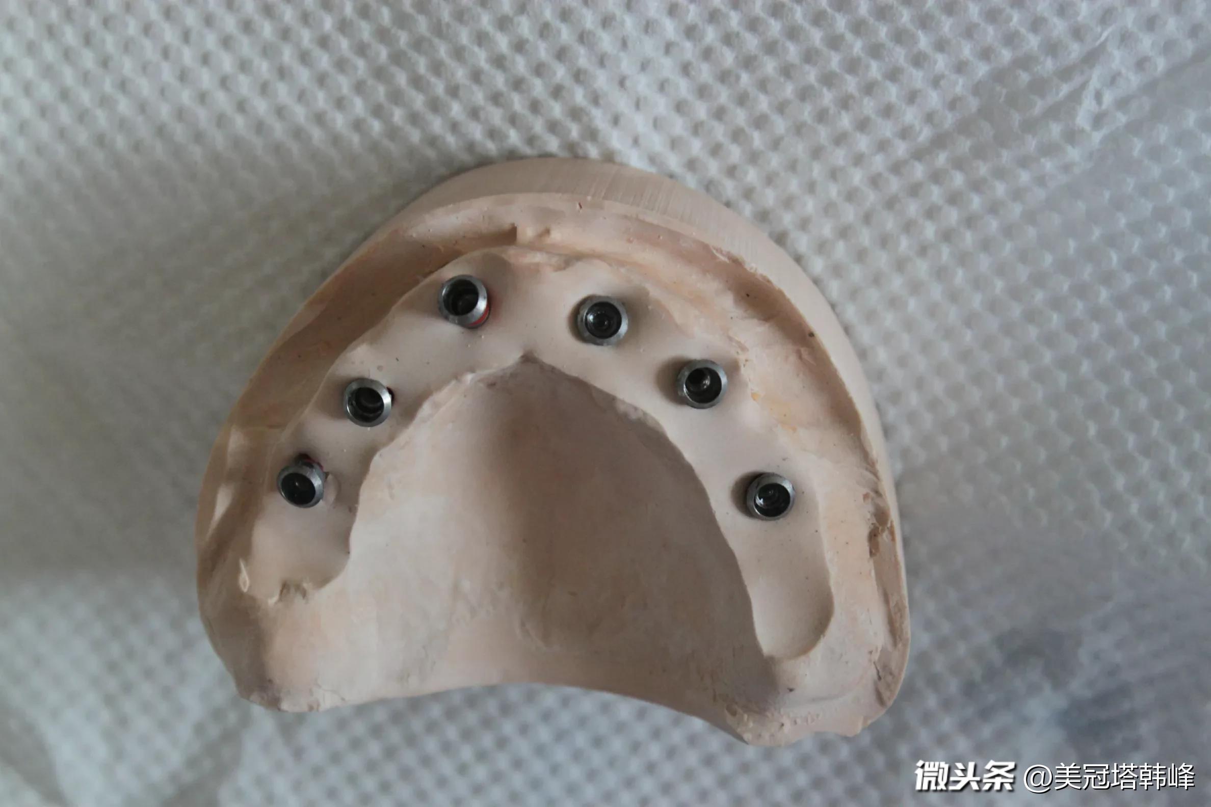 明明是去补牙,怎么倒把牙洞越磨越大了? - 今日